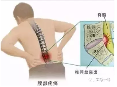 腰间盘突出是肝不藏血