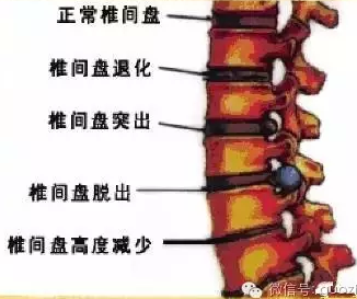 腰间盘突出是肝不藏血