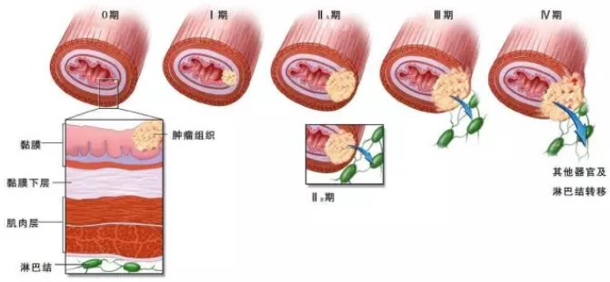 食管癌